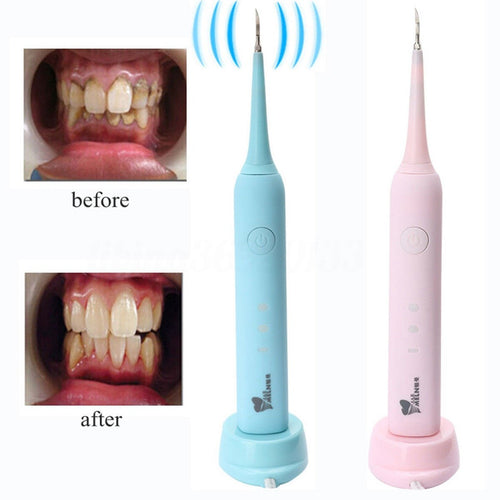 Electric Teeth Calculus and Stain Removal for Home